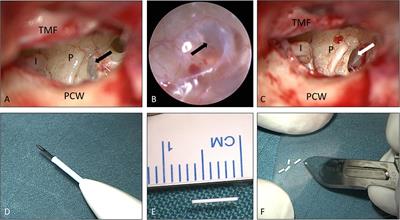 Safety and audiological outcome in a case series of tertiary therapy of sudden hearing loss with a biodegradable drug delivery implant for controlled release of dexamethasone to the inner ear